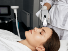 Morpheus-8 for glowing skin
